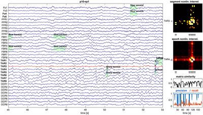 More Than Spikes: On the Added Value of Non-linear Intracranial EEG Analysis for Surgery Planning in Temporal Lobe Epilepsy